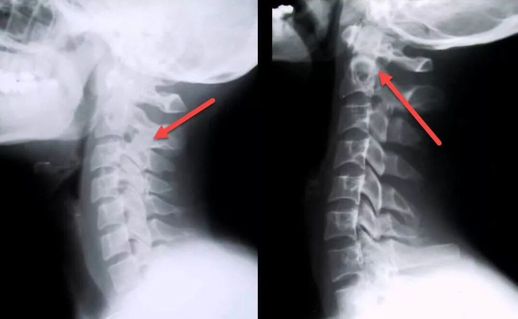 diagnosi di osteocondrosi cervicale