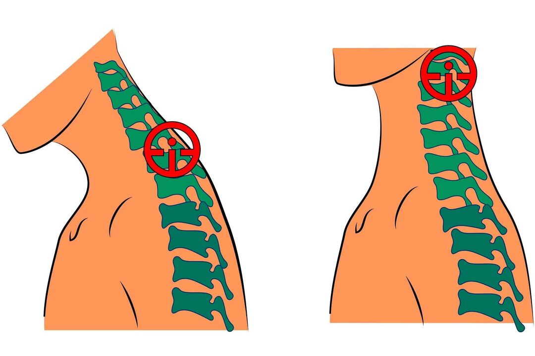 osteocondrosi cervicale