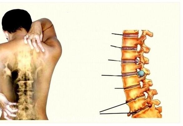 Fase dell'osteocondosi cervicale