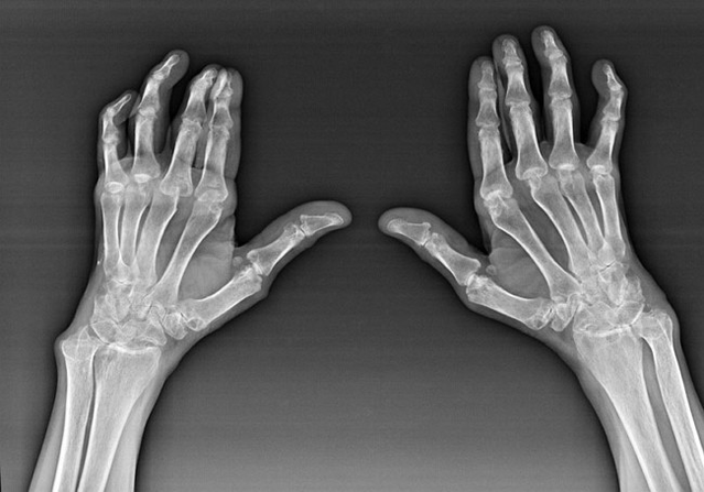 Diagnostica delle articolazioni delle dita