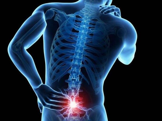 Con la radicolite, le radici nervose pizzicate provocano la comparsa di un dolore acuto nella parte bassa della schiena