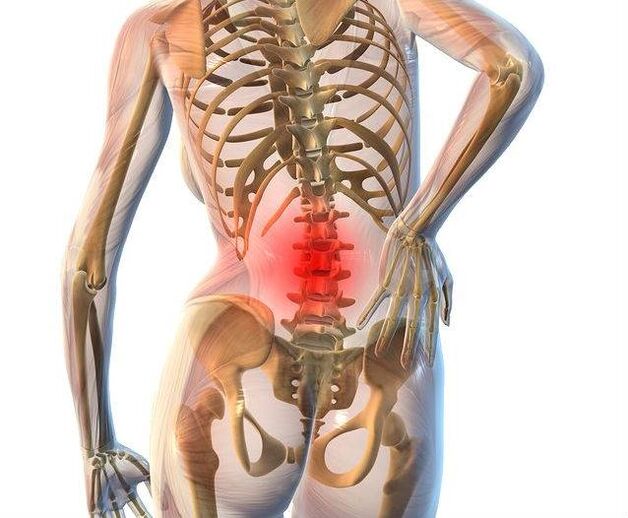 Osteocondrosi della colonna lombare