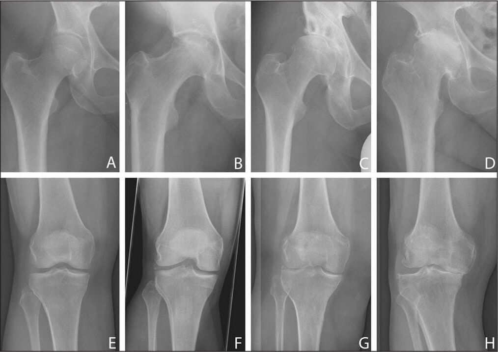Fasi di sviluppo dell'artrosi articolare su una radiografia