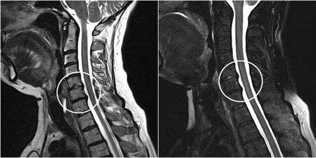 MRI del rachide cervicale con segni di osteocondrosi